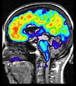 En röntgenbild på hjärnan hos en patient med mild kognitiv svikt. 
