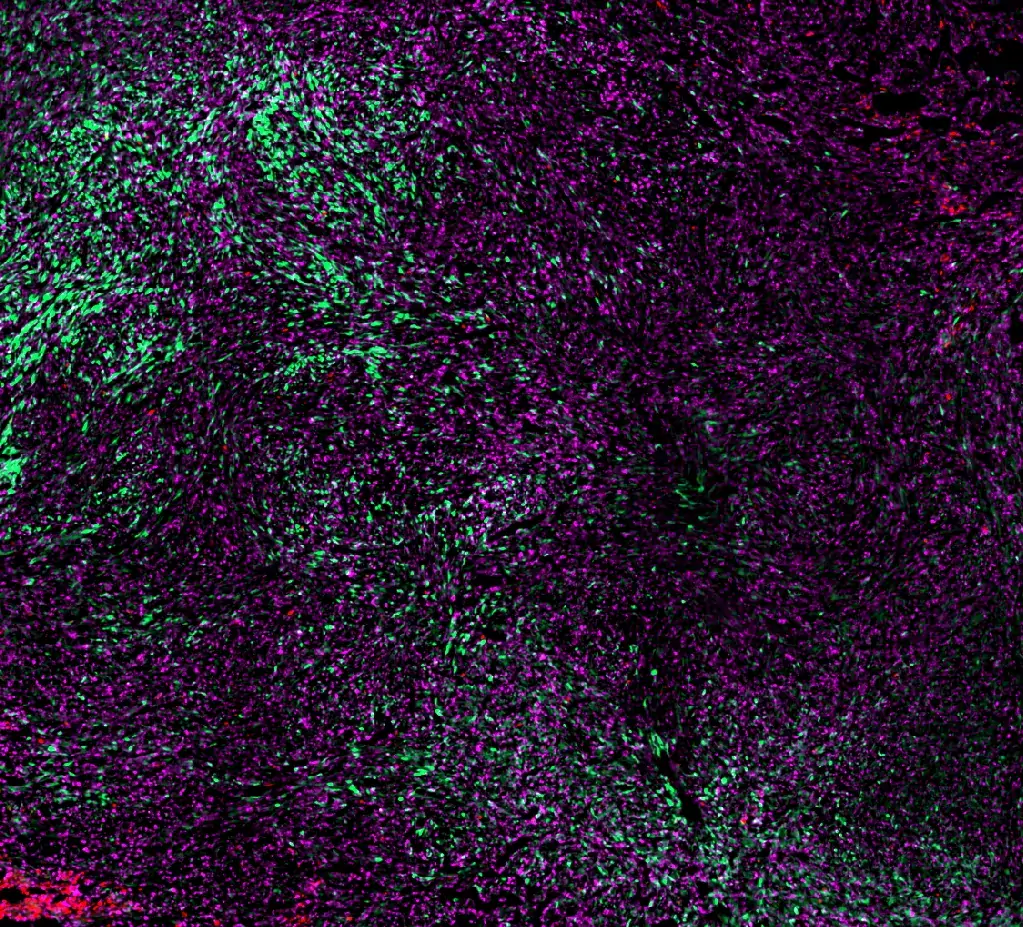 Enlarged microscope image of a mouse breast tumour, cancer cells appear green, immune cells in pink.
