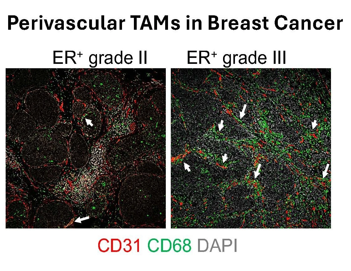 Two immune flourescence pictures of tumor associated macrophages in breast cancer.