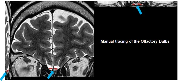 Image of the brain and blue arrows showing olfactory bulbs.