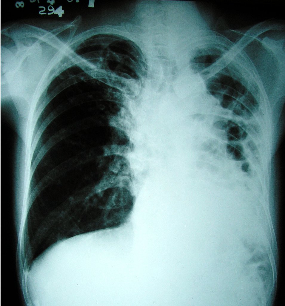 Xray of lungs previously infected with tuberculosis.