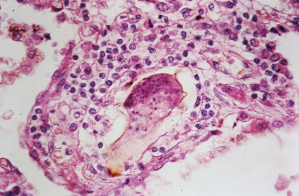 Schistosoma ovum in the lung parenchyma surrounded by a chronic inflammatory cellular infiltrate.
