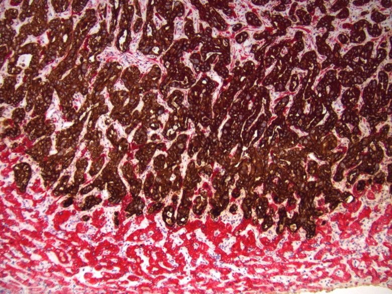Histology of a liver metastasis
