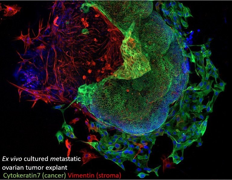 Research picture of Ex vivo cultured metastatic ovarian tumor explant