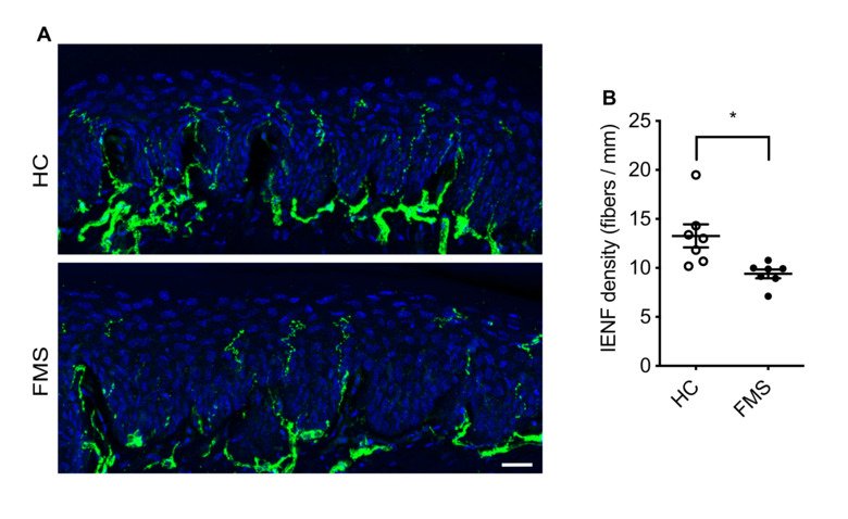 A picture of FM IgG transfer also decreases intraepidermal nerve fiber density