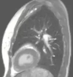 Magnetresonanstomografi (MR) bild av thorax.
