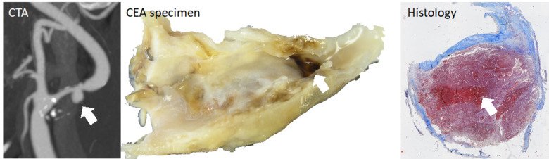 Patient with Carotisstenos , CT antiography