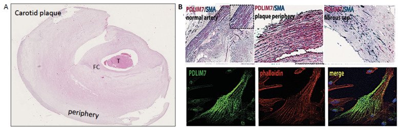 An example of a human carotid atherosclerotic plaque