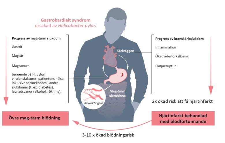 Illustration gastrokardialt syndrom orsakat av helicobacter pylori