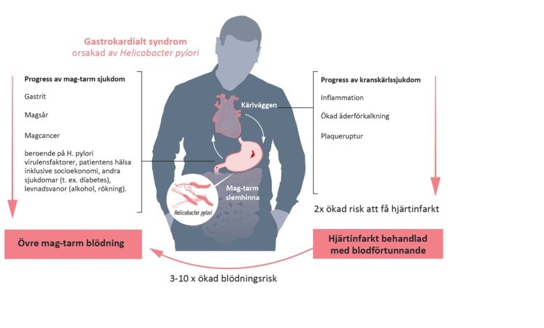 Illustration gastrokardialt syndrom orsakat av helicobacter pylori