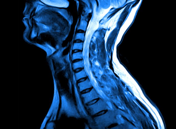 MRI av halsryggen