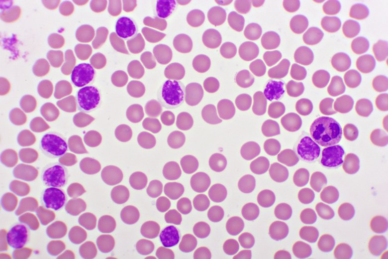 Akut lymfatisk leukemi i blodprov
