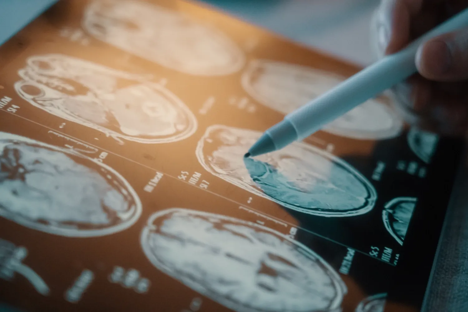 Läkare pekar med en penna på en hjärnavbildning.