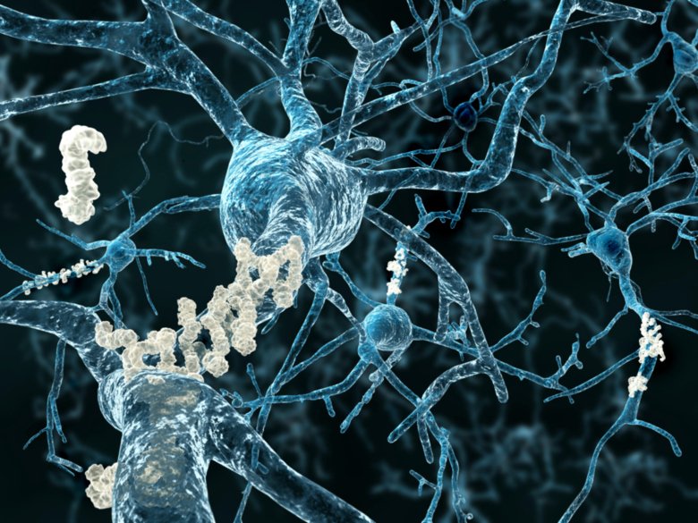 Amyloid plaques in the brain in Alzheimer's disease