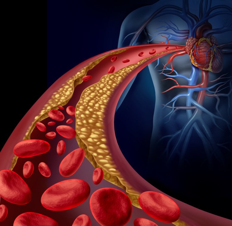 Illustration of arteries clogged with cholesterol.