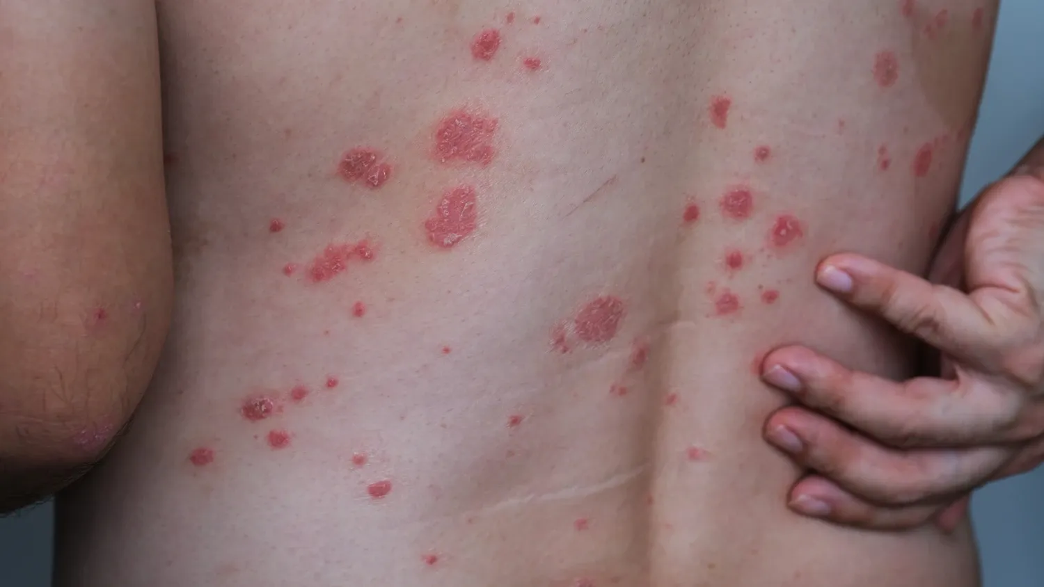 A man with psoriasis on his back