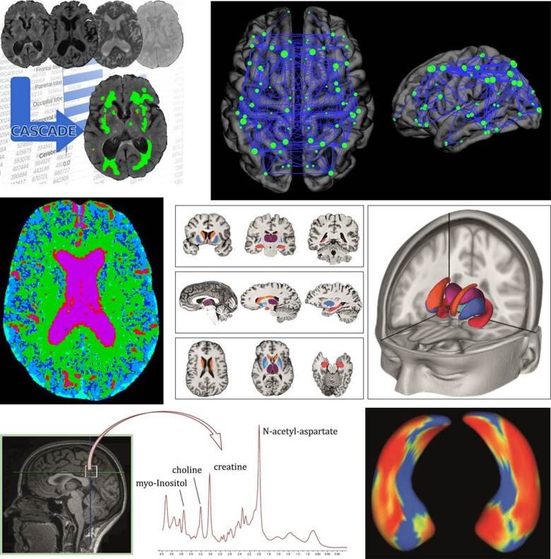 imaging of brain with alzheimer