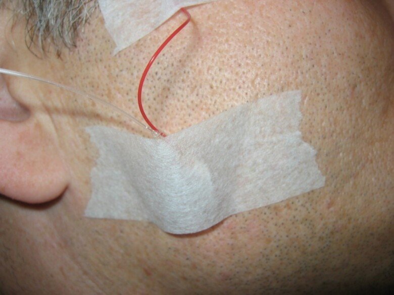 Close-up of patient with a thin catheter that goes into his cheek and another one that goes out of the cheek.