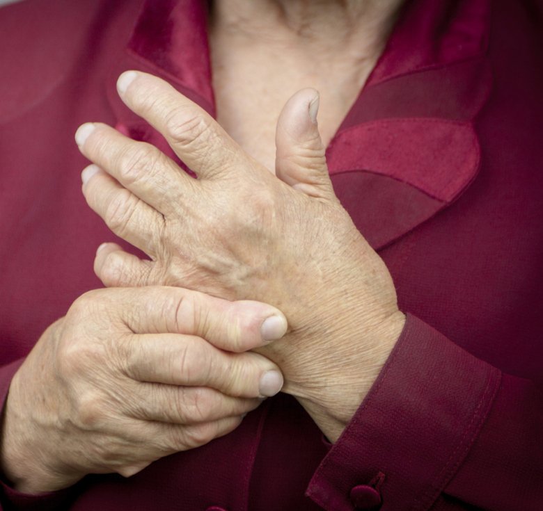 Image of woman with rheumatoid arthritis in her hands