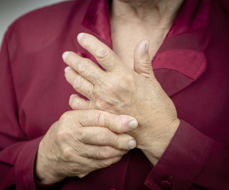 Image of woman with rheumatoid arthritis in her hands