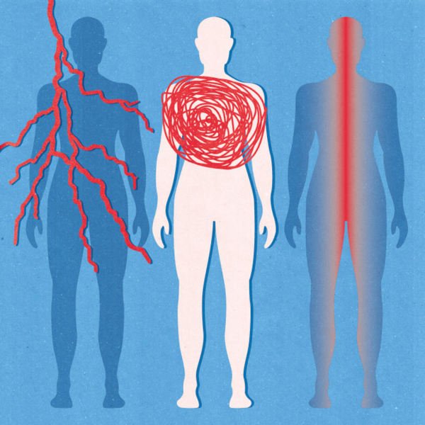 Illustration of sarcoidoisis