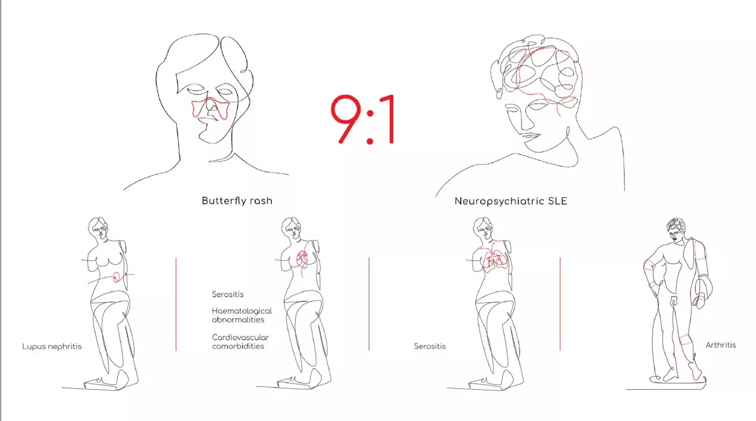 The illustration depicts some of the manifestations of systemic lupus erythematosus.