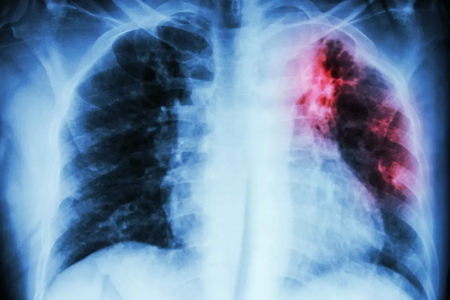 Röntgen av lungor med tuberkulos