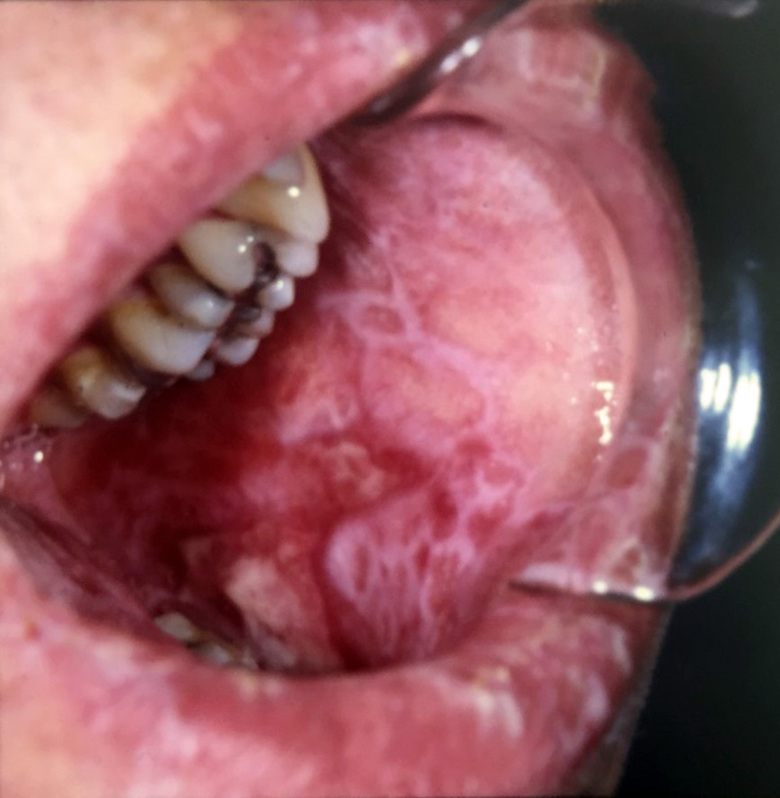 A close-up of an open mouth where the inside of the cheek is covered with sores