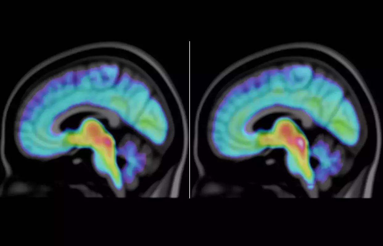 A visualisation of the average serotonin transporter concentration in people with ASD, autism spectrum disorder (left) and people without ASD (right). Graphics: Max Andersson