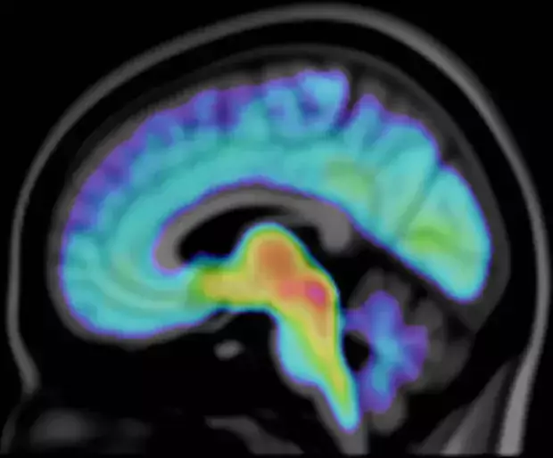 A visualisation of the average serotonin transporter concentration in ASD, autism spectrum disorder.