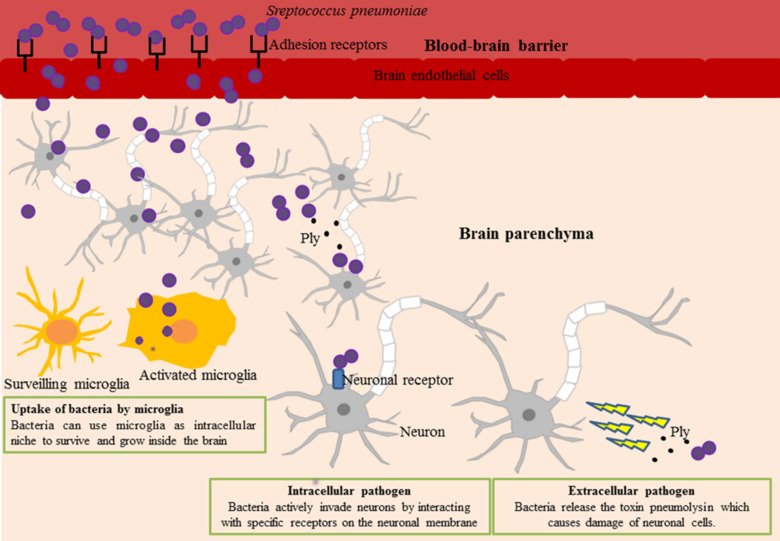 Illustration of Pneumococcal infections of the brain.