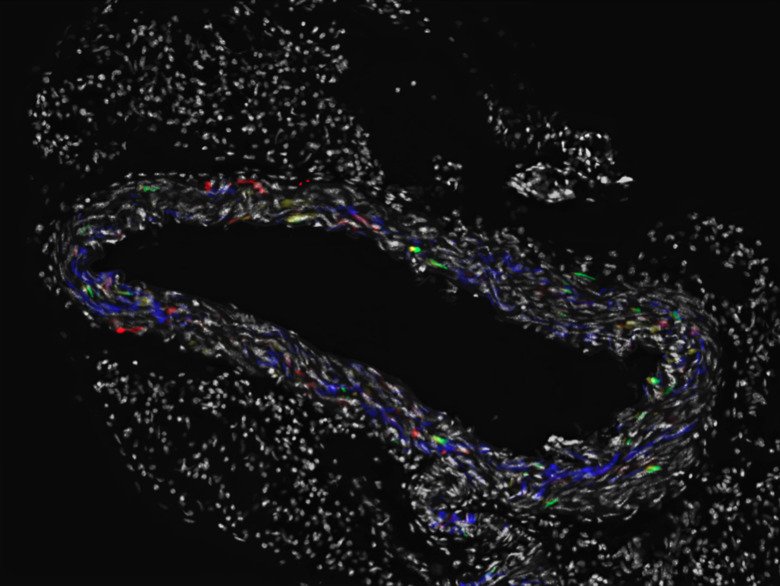 Clonal propagation of vascular smooth muscle cells in the thoracic aorta using confetti reporter mouse.