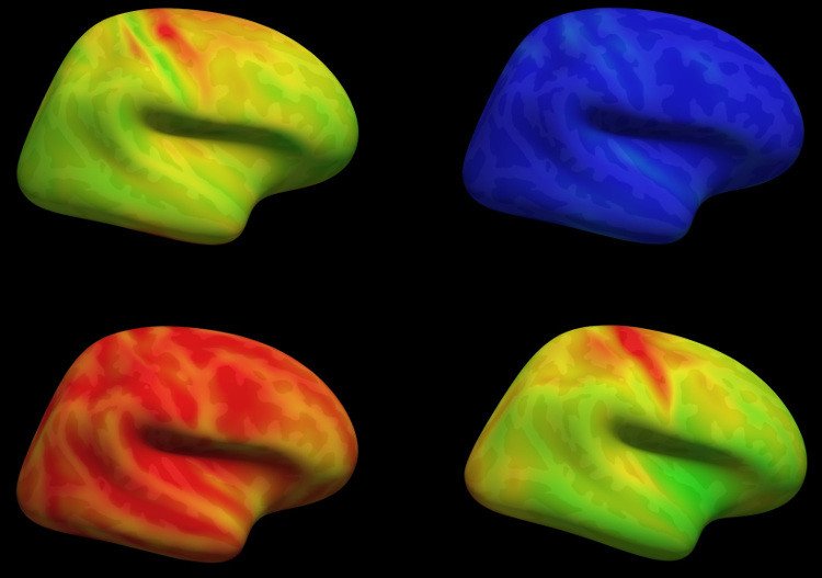 Cortical MS pathology is visualized