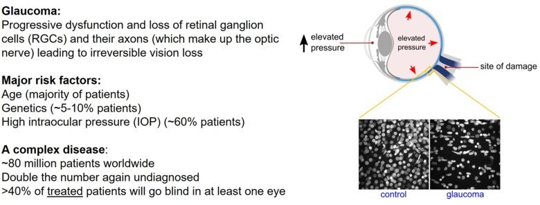 Williams overview glaucoma