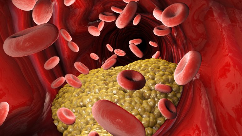 Narrowing of a blood vessel