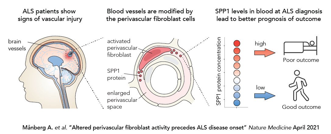 The study presents a cell in the brain blood vessels as a possible explanation for the varying disease course in ALS. The results highlight a previously unknown relationship between the nervous and vascular systems in ALS.