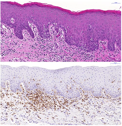 Microscopy images of tissue samples taken from inside the cheek, showing tissue structure and localisation of different cell types in patients after blood stem cell transplantation.