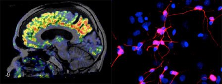 left image represents amyloid imaging and right image represents grafted stem cells.