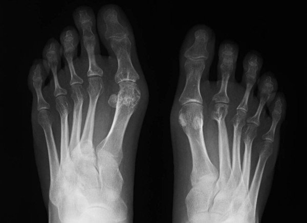 X-ray of feet.