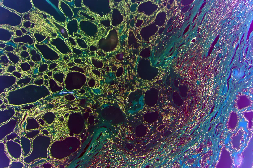 Dekorativ histologisk bild av en tumör.