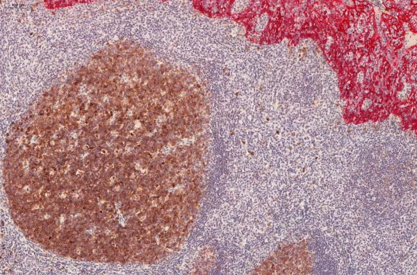 Image of CD10 (DAB) & KTR19 Fast Red IHC Double stain tonsil