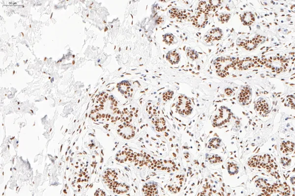 Image of NuMA IHC, breast carcinoma
