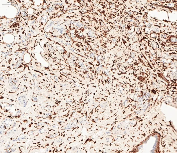 Image of Vimentin IHC, breast carcinoma
