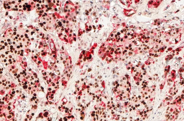Image of p53 (DAB) & CD8 (Fast Red) IHC Double stain, breast cancer