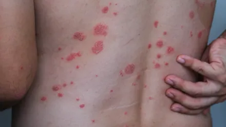 A man with psoriasis on his back